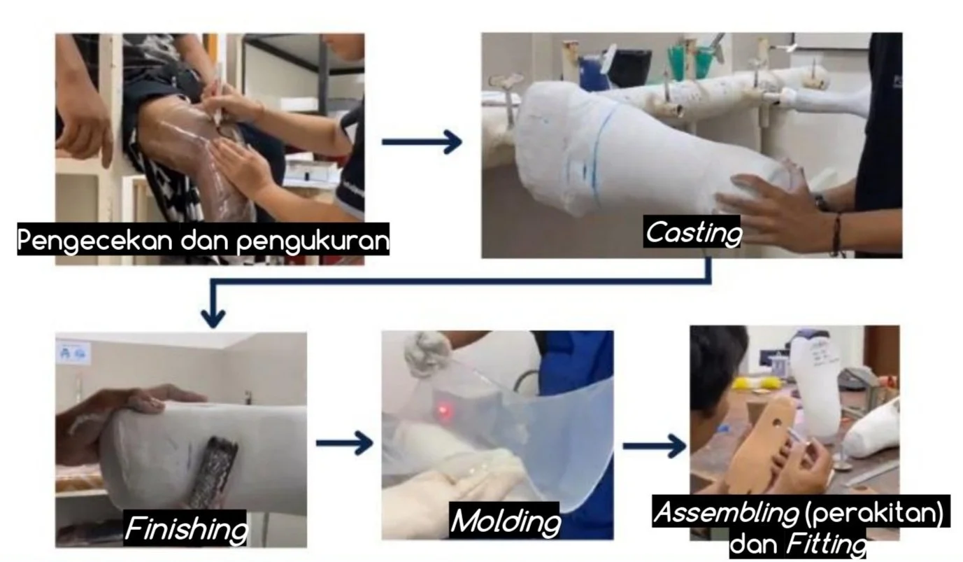 Prosthetic Leg